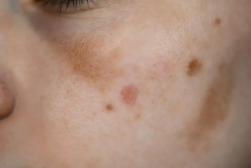 মুখের কালো দাগ: ৫টি পরীক্ষিত ও নিরাপদ উপায়